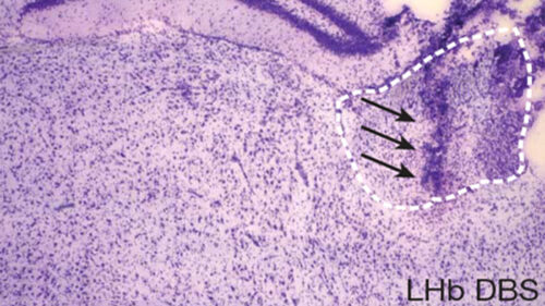 Unlocking the Brain: How the Lateral Habenula Influences Depression and Ketamine Therapy